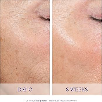 Active Peel System
